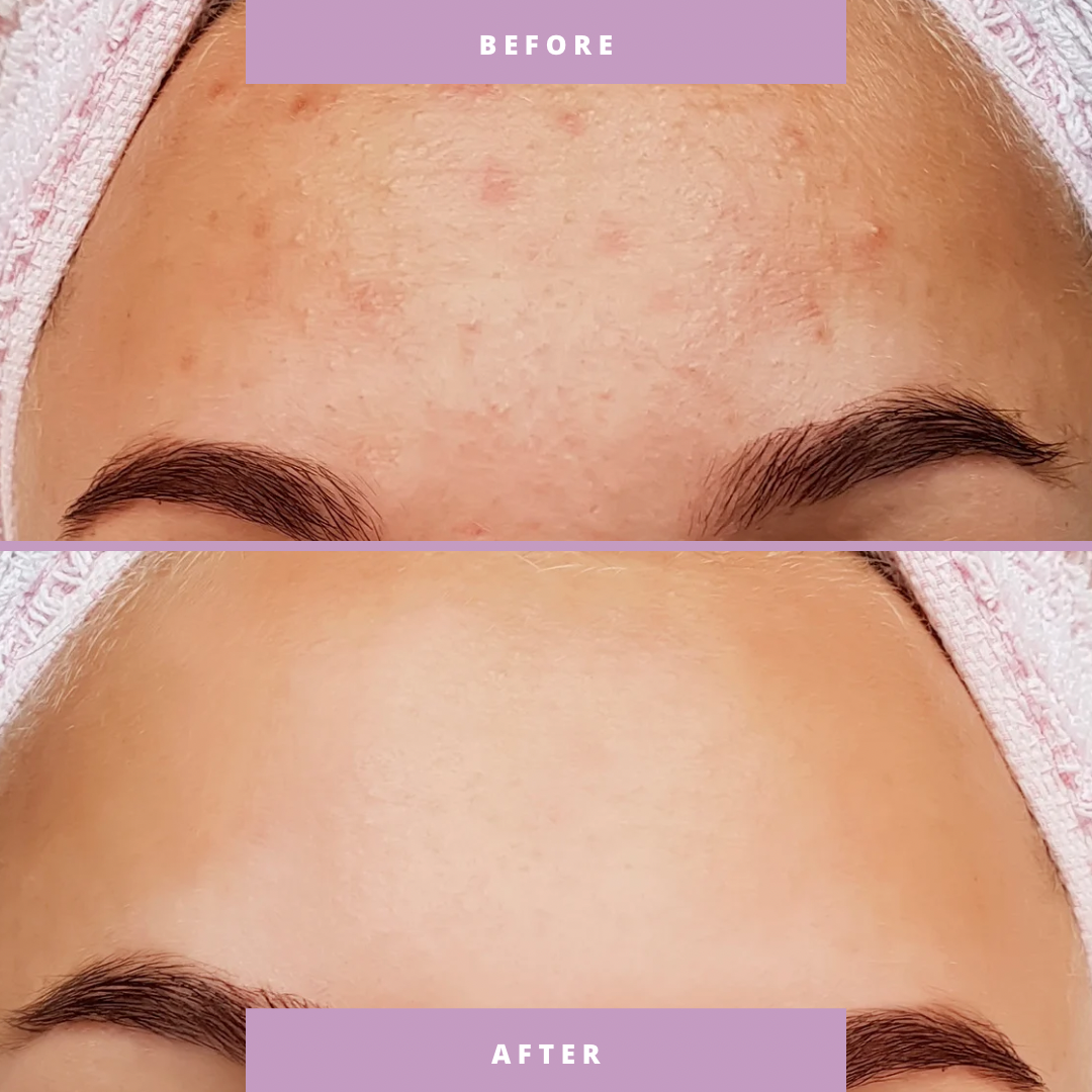 HydraGlow™ I Deep cleansing for pore-deep clean skin!